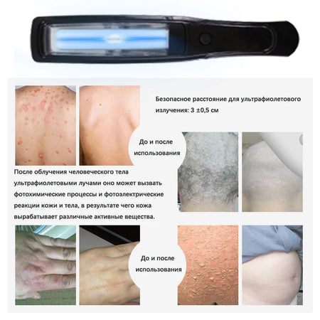 UVB Vitiligo Therapy Light UV311nm Lamp &ndash; Clinical UV Lamp