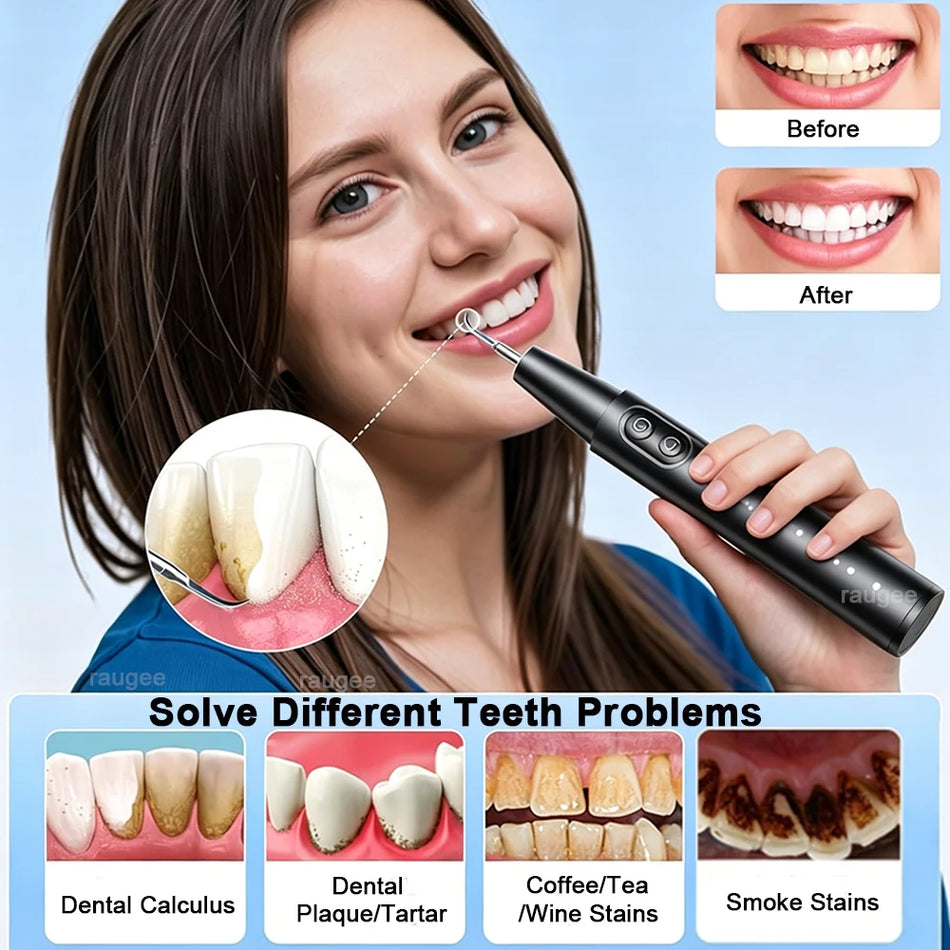 Ultrasonic Dental Scaler for Tartar, Calculus, and Plaque Removal