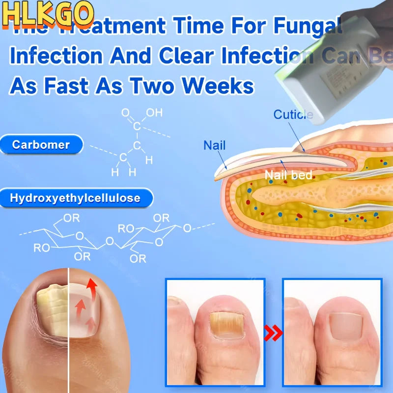 Prenosna naprava za lasersko zdravljenje glivic na nohtih za domačo uporabo moške ženske