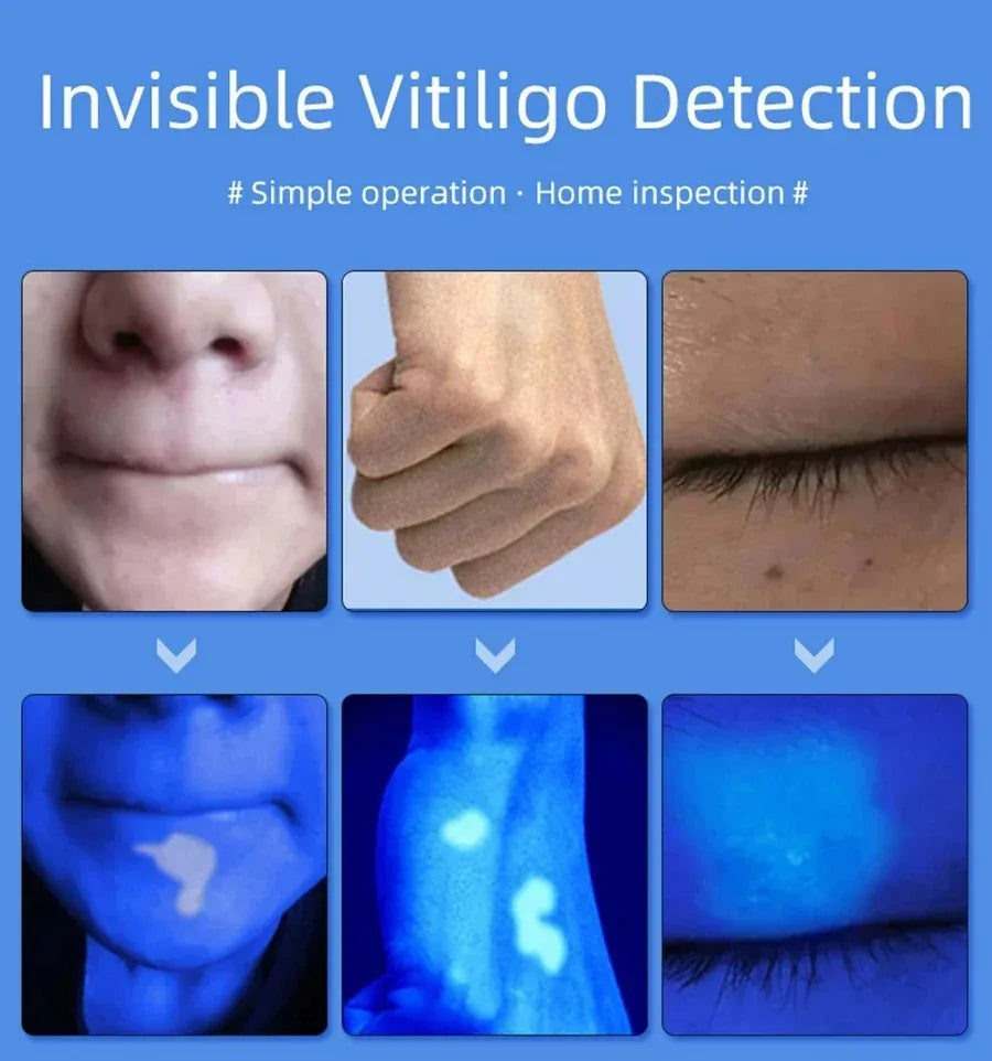 Woods Lamp Skin Analyzer &ndash; UV Skin Analysis Device