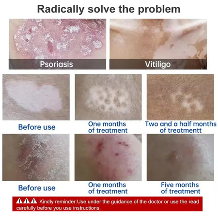 UVB Vitiligo Therapy Light UV311nm Lamp &ndash; Clinical UV Lamp