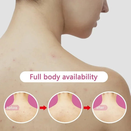 Plasma Facial Massager &ndash; Blue Light Ozone Therapy Device