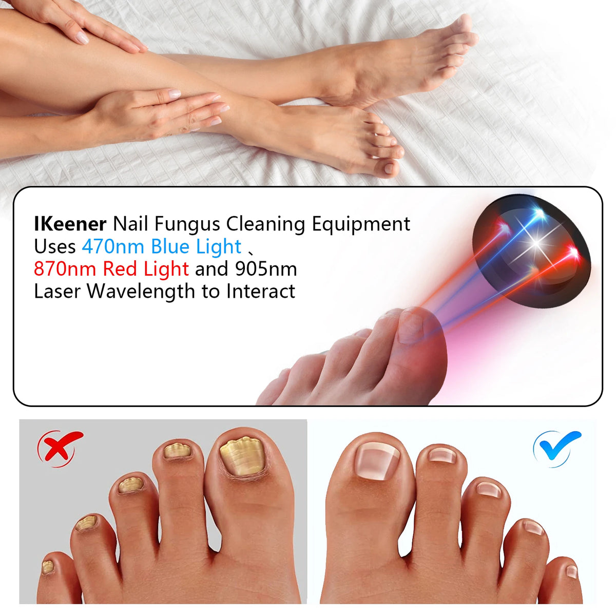 KTS Nail Fungus Laser Device &ndash; Fast Toenail Fungus Treatment