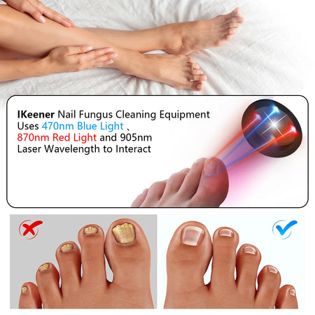 KTS Nail Fungus Laser Device &ndash; Fast Toenail Fungus Treatment