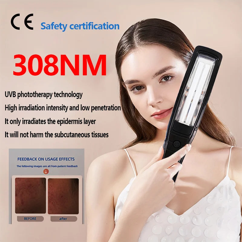 UVB Vitiligo Therapy Light UV311nm Lamp &ndash; Clinical UV Lamp