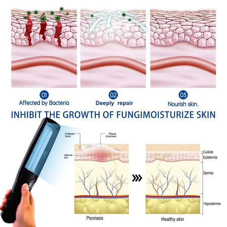 UVB Vitiligo Therapy Light UV311nm Lamp &ndash; Clinical UV Lamp